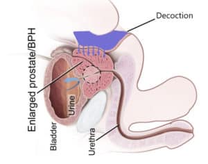 Inflamed prostate treatment