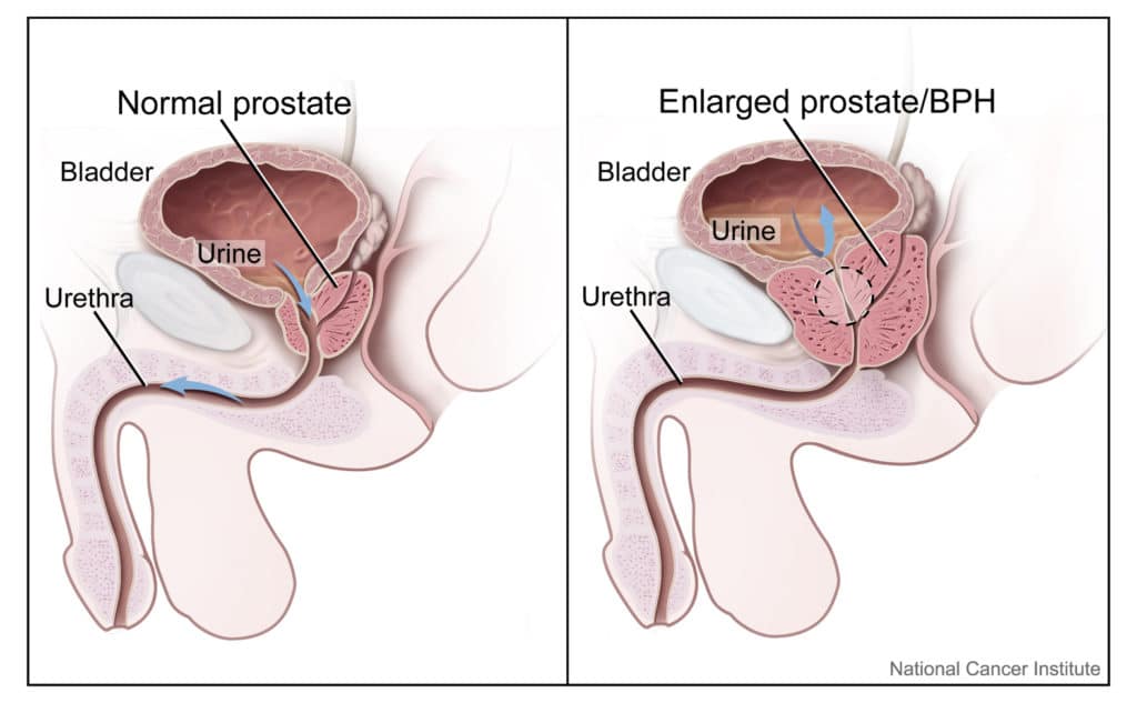 Prostate: size and location (normal and enlarged)