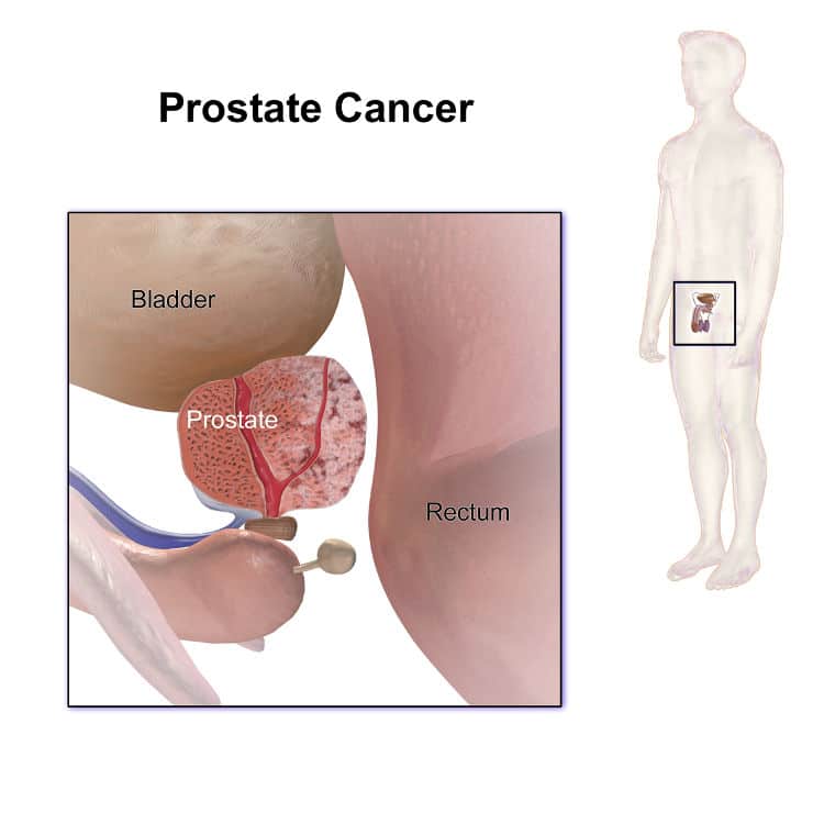 Prostate Cancer|yourhealthyprostate.com - YOUR HEALTHY PROSTATE - HOW TO CURE PROSTATE ONCE AND FOR ALL AND KEEP IT HEALTHY