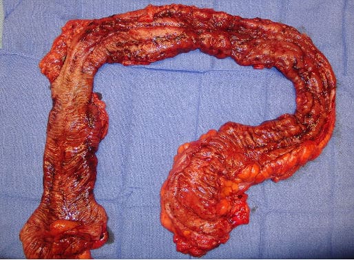 ulcerative colitis