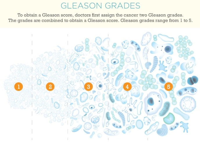 Gleason Grades Infographic|yourhealthyprostate.com-Your Healthy Prostate   