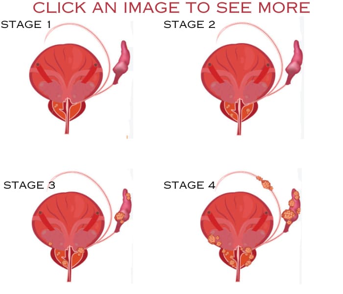 Prostate cancer stages
