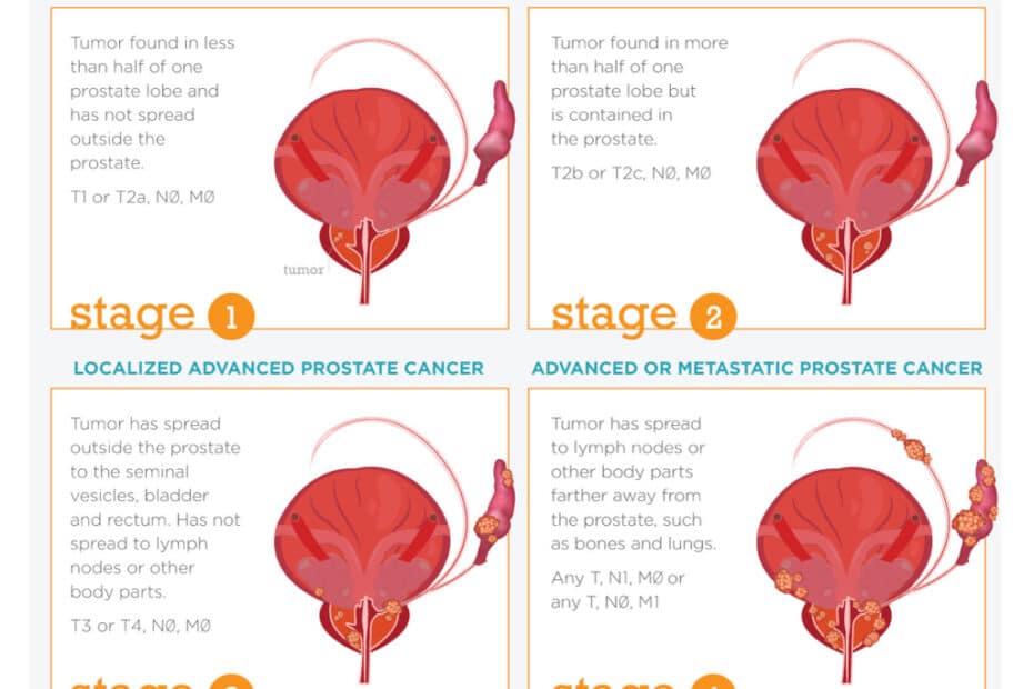 Prostate Cancer Stages|yourhealthyprostate.com-Your Healthy Prostate   