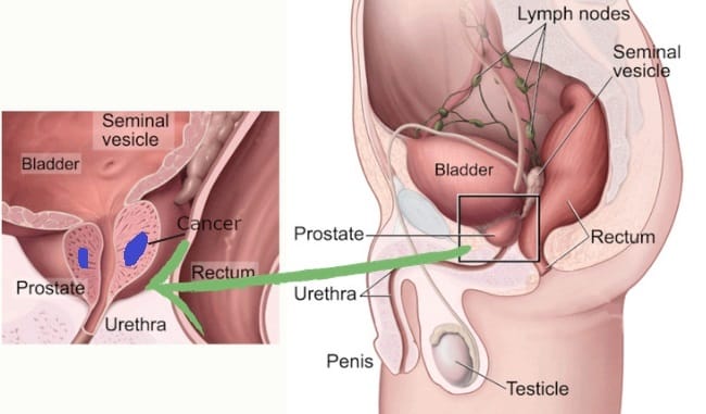 prostate_cancer_st2|yourhealthyprostate.com-Your Healthy Prostate   