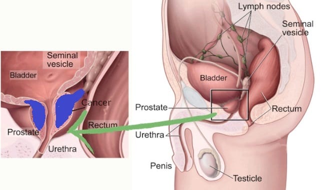 prostate_cancer_st3|yourhealthyprostate.com-Your Healthy Prostate   