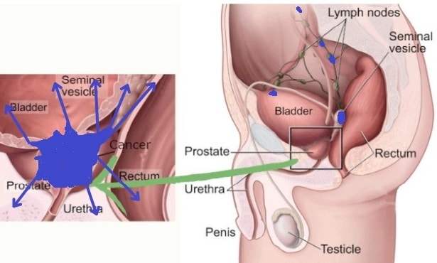 prostate cancer st4|yourhealthyprostate.com-Your Healthy Prostate   