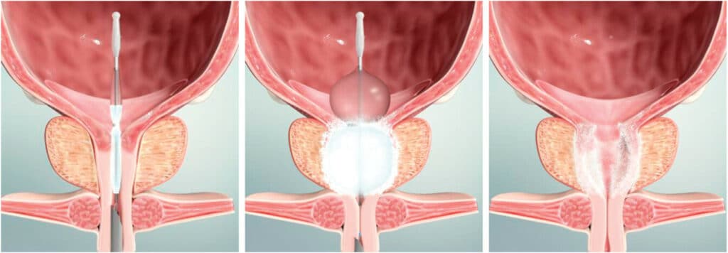 optilume BPH treatment|yourhealthyprostate.com-Your Healthy Prostate