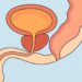 Realistic medical illustration of male pelvic anatomy showing bladder, prostate gland, and urethra in cross-section, highlighting how the prostate surrounds the urethra beneath the bladder