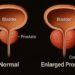 Medical illustration of bladder and prostate showing prostate enlargement pressing against the bladder neck and narrowing the urethra, with slider motif indicating progression.